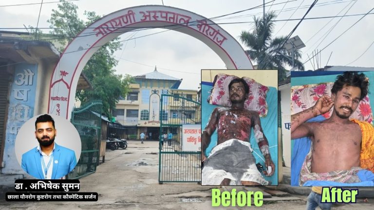 नारायणी अस्पताल : डा. अभिषेकको पहल र टोलीको समर्पणले जोगियो धर्मपालको जीवन